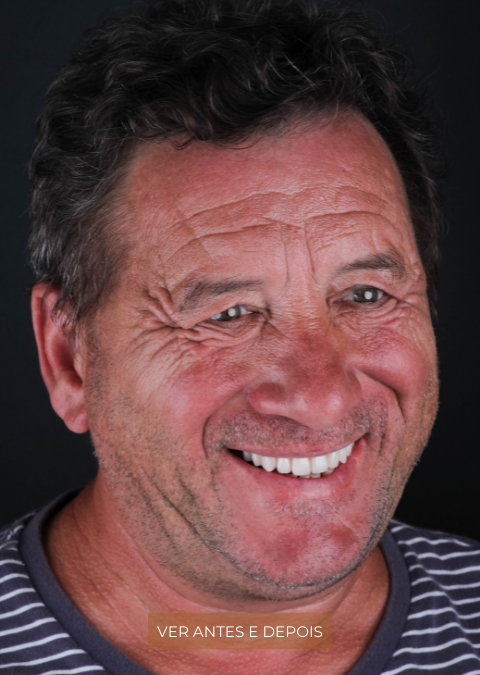 O realizar de um sonho com Dentes Fixos em 1 Dia