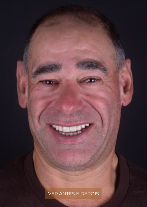 Novo sorriso com o tratamento de Coroas Cerâmicas