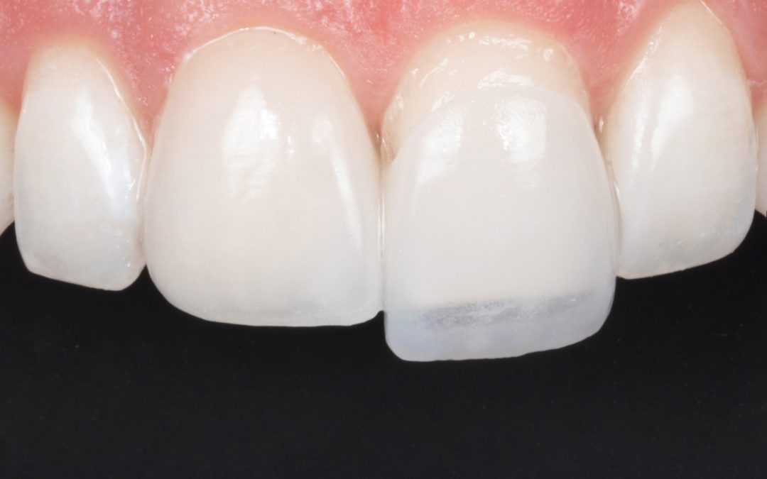 1 dente partido? Tratamento Facetas Dentárias