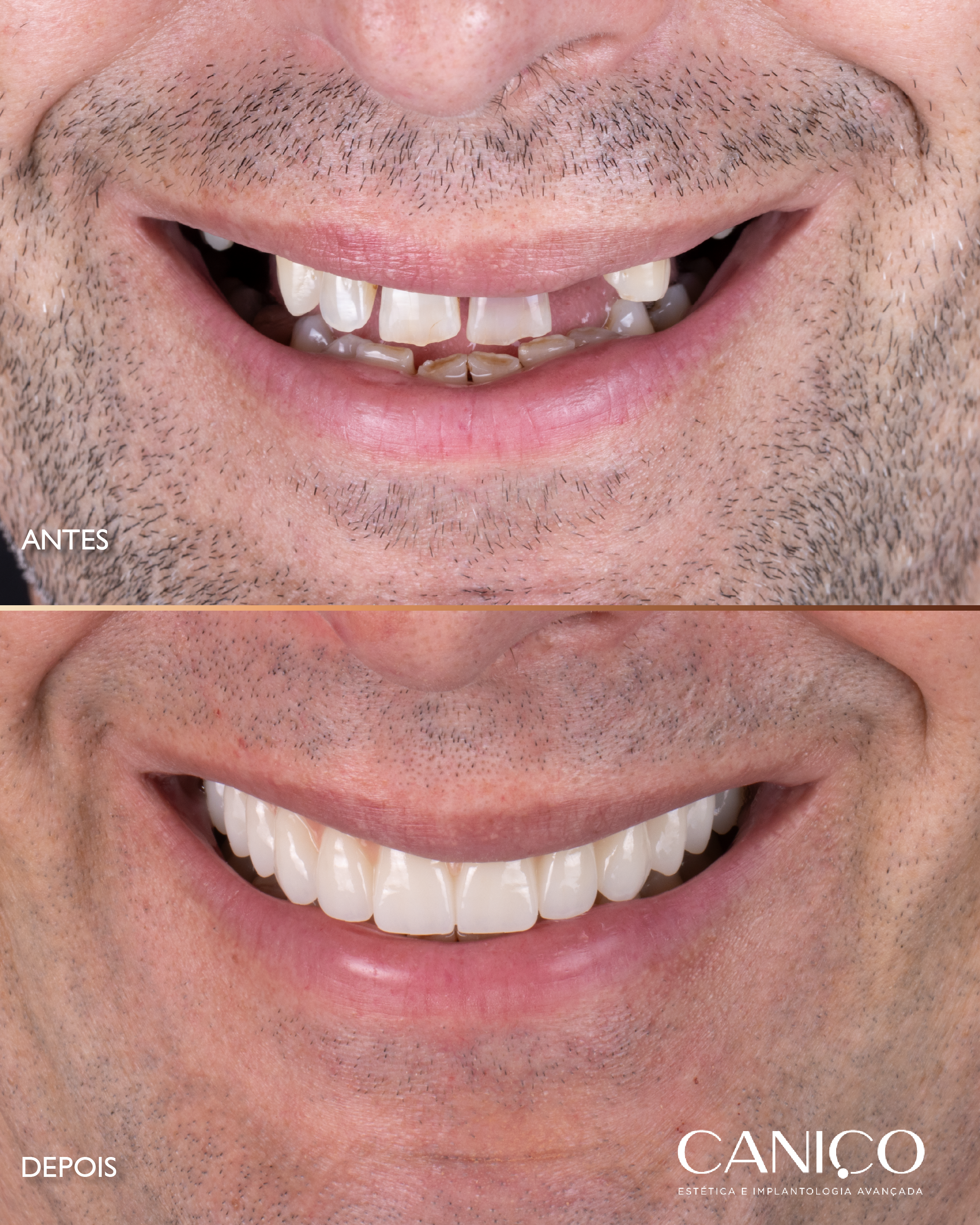 Transformação do sorriso após os 50 anos