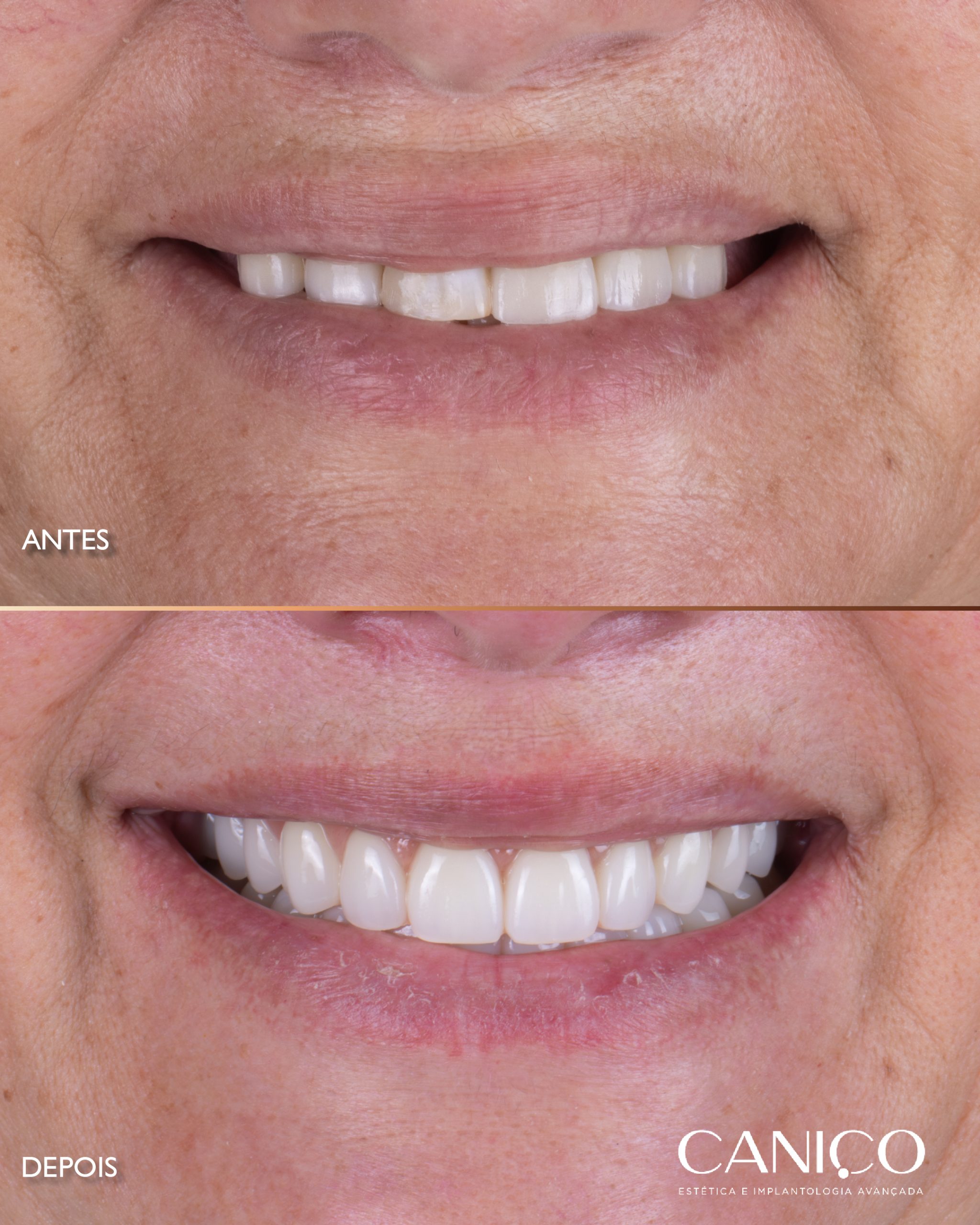 Transformação do sorriso após os 50 anos
