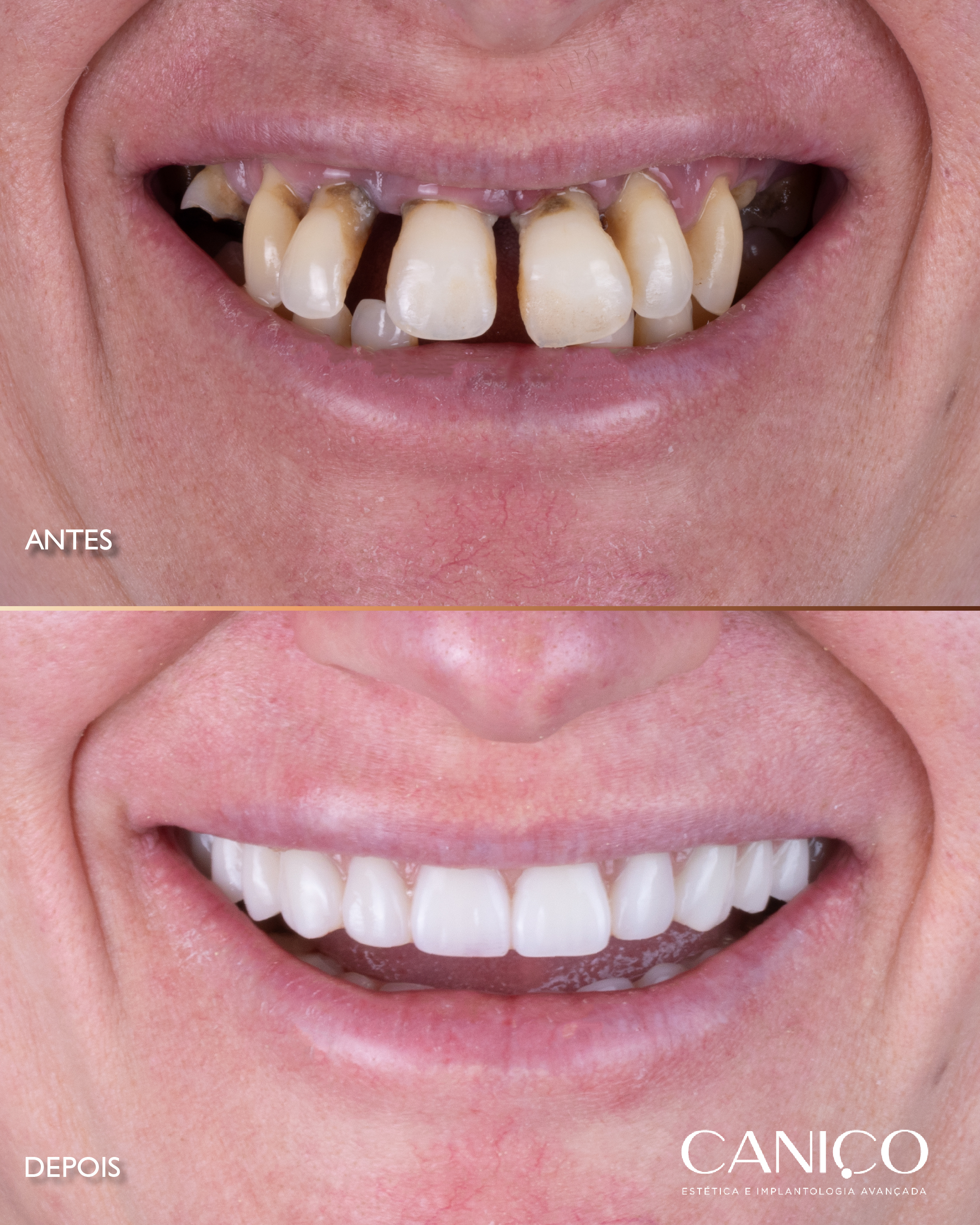 Transformação do sorriso após os 50 anos
