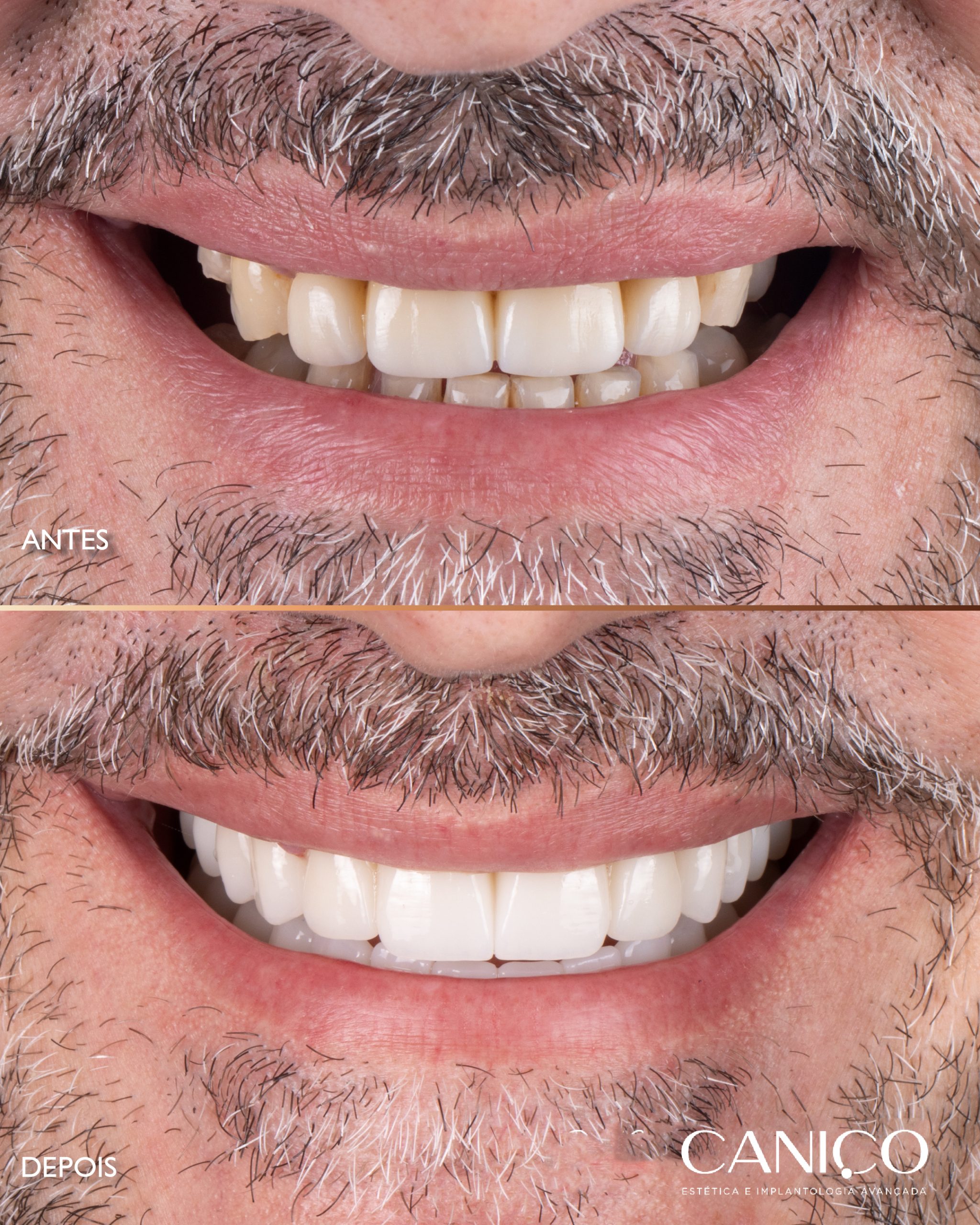 Transformação do sorriso após os 50 anos