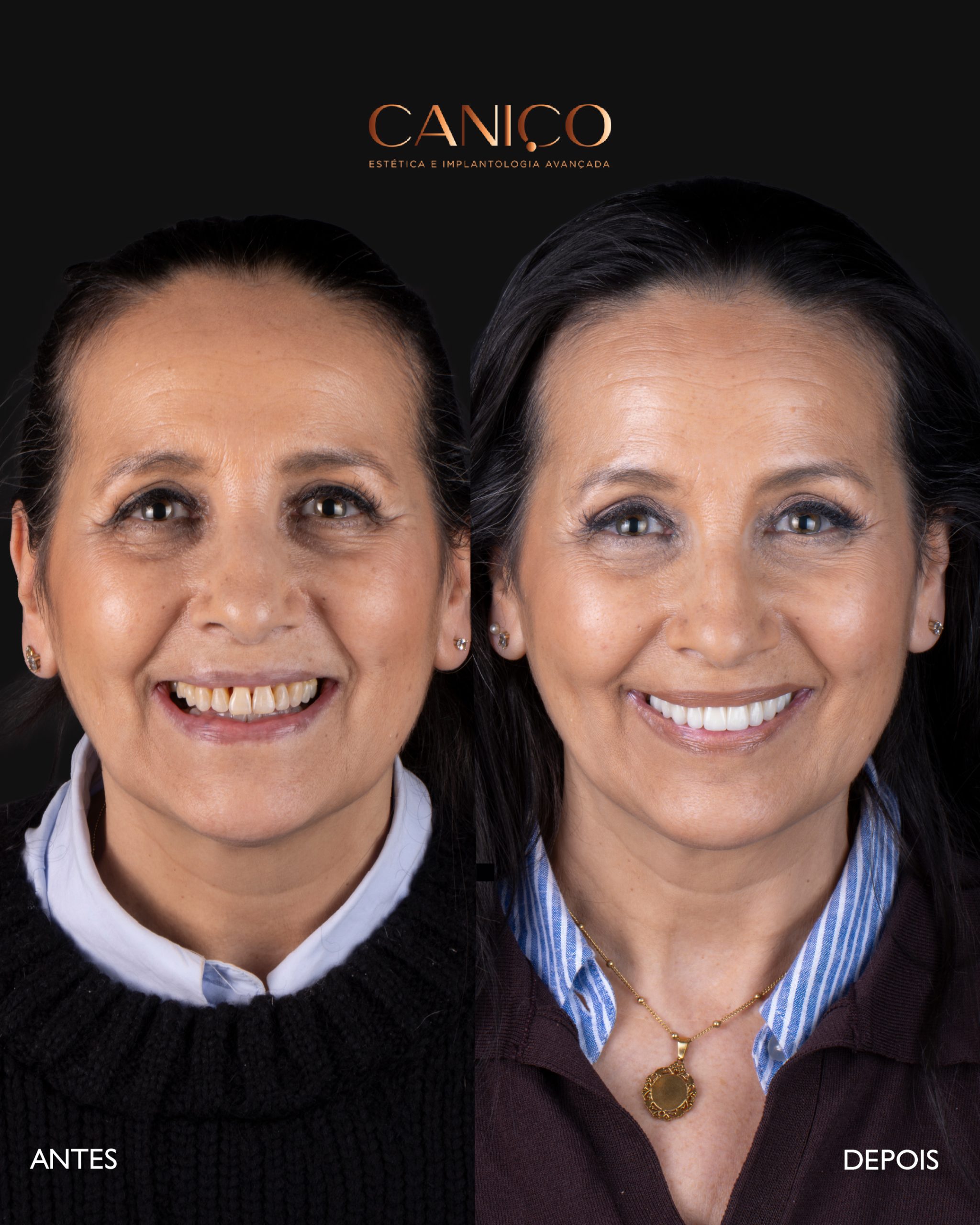 Transformação do sorriso após os 50 anos