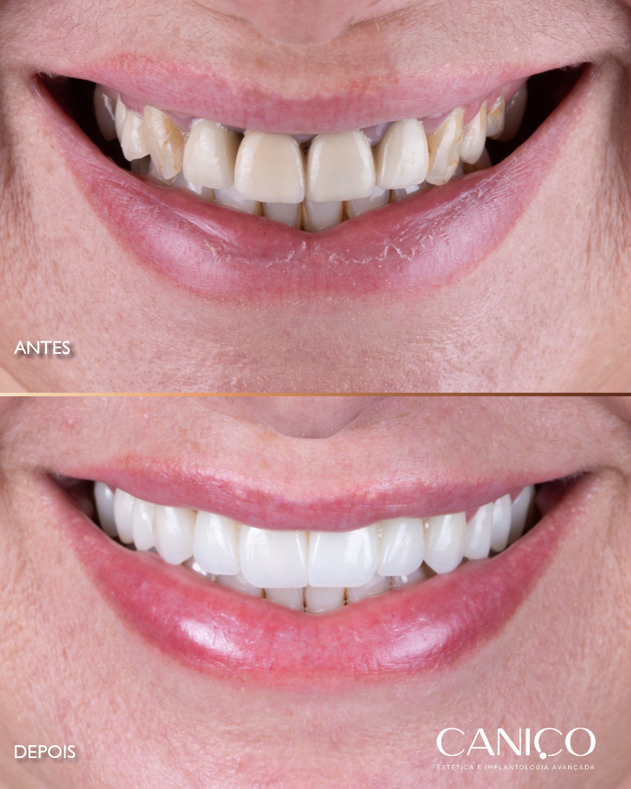Transformação do sorriso após os 50 anos