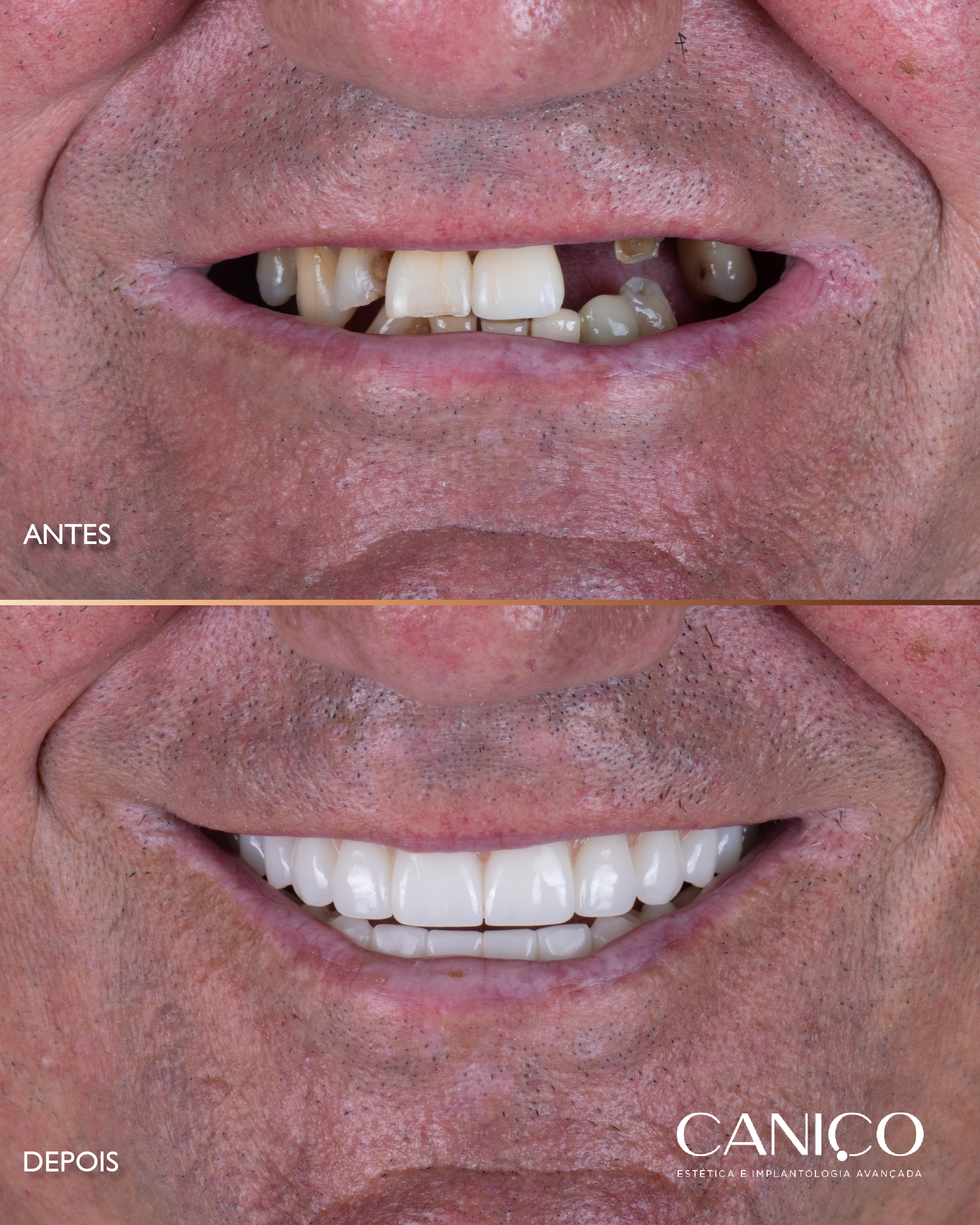 Transformação do sorriso após os 50 anos