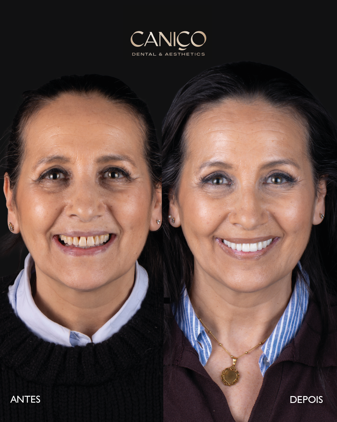 Implantologia - implantes dentários